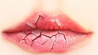 وصفات لعلاج تشقق الشفاه