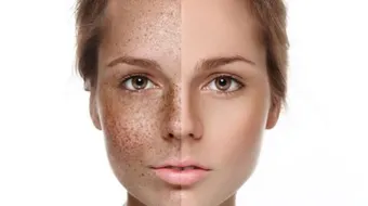 وصفات لعلاج الكلف