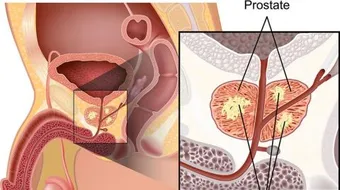 إنتشار مرض البروستاتا
