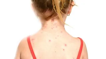 الوقاية من مرض الحصبة