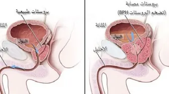 مرض البروستاتا