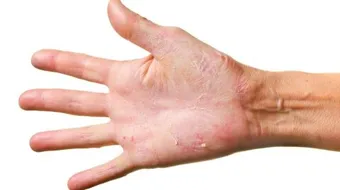 علاج مرض الصدفية