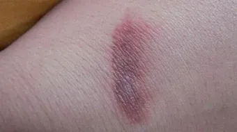 إزالة آثار الحروق بسرعة