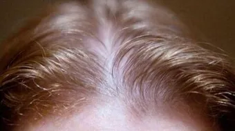 أسباب ضعف نمو الشعر