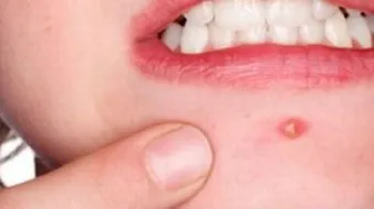 أسباب ظهور الحبوب الحمراء في الجسم