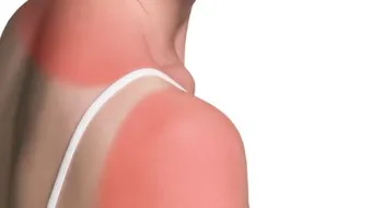 وصفات للتخلص من حروق الشمس