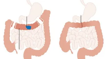 أورام المستقيم وأعراضها