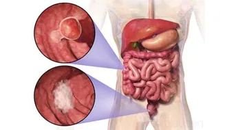 أورام المستقيم