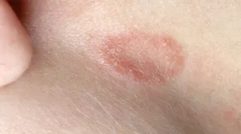 ظهور بقع حمراء على جلد الطفل