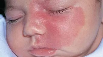 ظهور بقع حمراء على الوجه