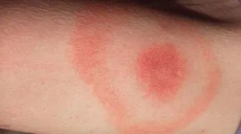 ظهور بقع حمراء على الجلد عند الأطفال