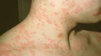 ظهور بقع حمراء على الجلد