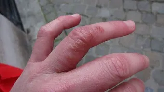 ظهور بقع حمراء تحت الجلد في اليد