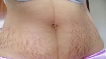 إزالة تشققات الحمل