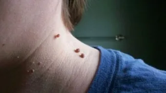 إزالة الزوائد الجلدية