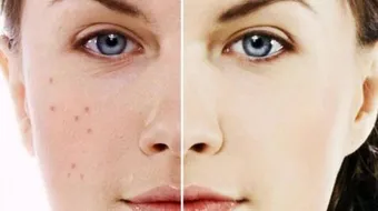 إزالة حب الشباب