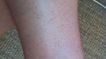 إزالة النقط السوداء من الساقين