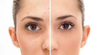 إزالة البثور من الوجه