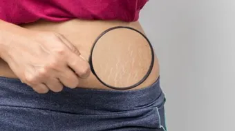 إزالة الخطوط الحمراء من الجسم