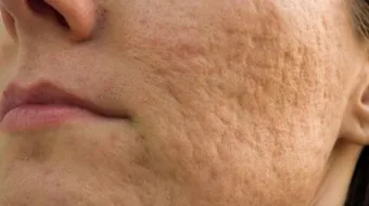 إزالة حفر الوجه