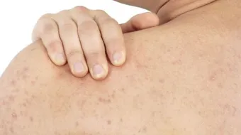 إزالة الحبوب من الظهر