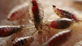 إزالة الصيبان من الشعر