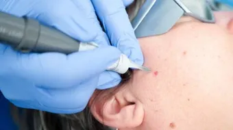 إزالة حبة الخال