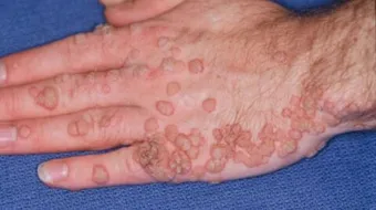 إزالة الثآلول