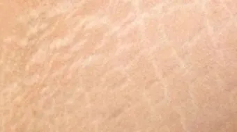 إزالة الخطوط البيضاء من الجسم