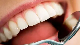 إزالة التسوس من الأسنان