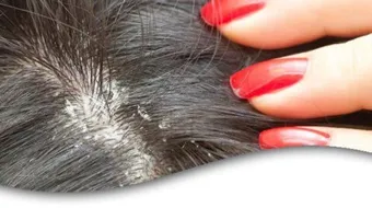 إزالة القشرة من الشعر نهائياً