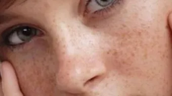 إزالة النمش من الوجه نهائياً