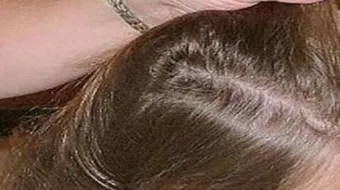 إزالة القمل والصيبان نهائياً