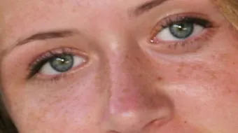 إزالة الكلف من الوجه طبيعياً