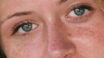 إزالة الكلف من الوجه نهائياً