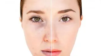 إزالة التصبغات من الوجه