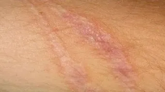 إزالة آثار الجروح القديمة