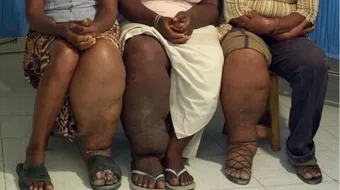 بحث عن داء الفيل