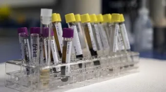 تحليل الروماتويد