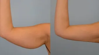 ترهل الجلد بعد فقدان الوزن