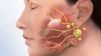 سرطان الغدد اللعابية