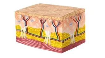 آثار حروق الدرجة الثانية