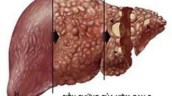 سرطان الكبد الثانوي