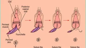 العناية بالخياطة بعد الولادة