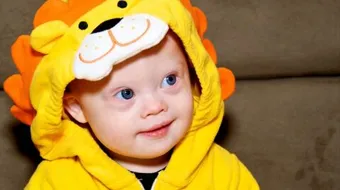 علامات مرض داون