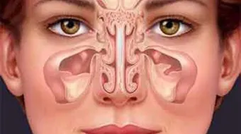 التهاب الجيوب الأنفية
