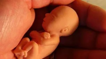 صغر حجم الجنين في الشهر الثالث