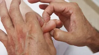 حل مشكلة الظفر الغائر