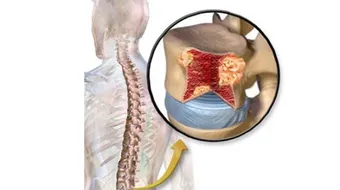 أورام النخاع الشوكي