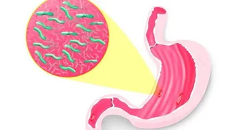 قرحة المعدة وقرحة الاثني عشر